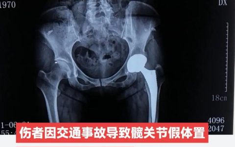 盆骨骨折伤残等级如何判定？专家详解标准与流程