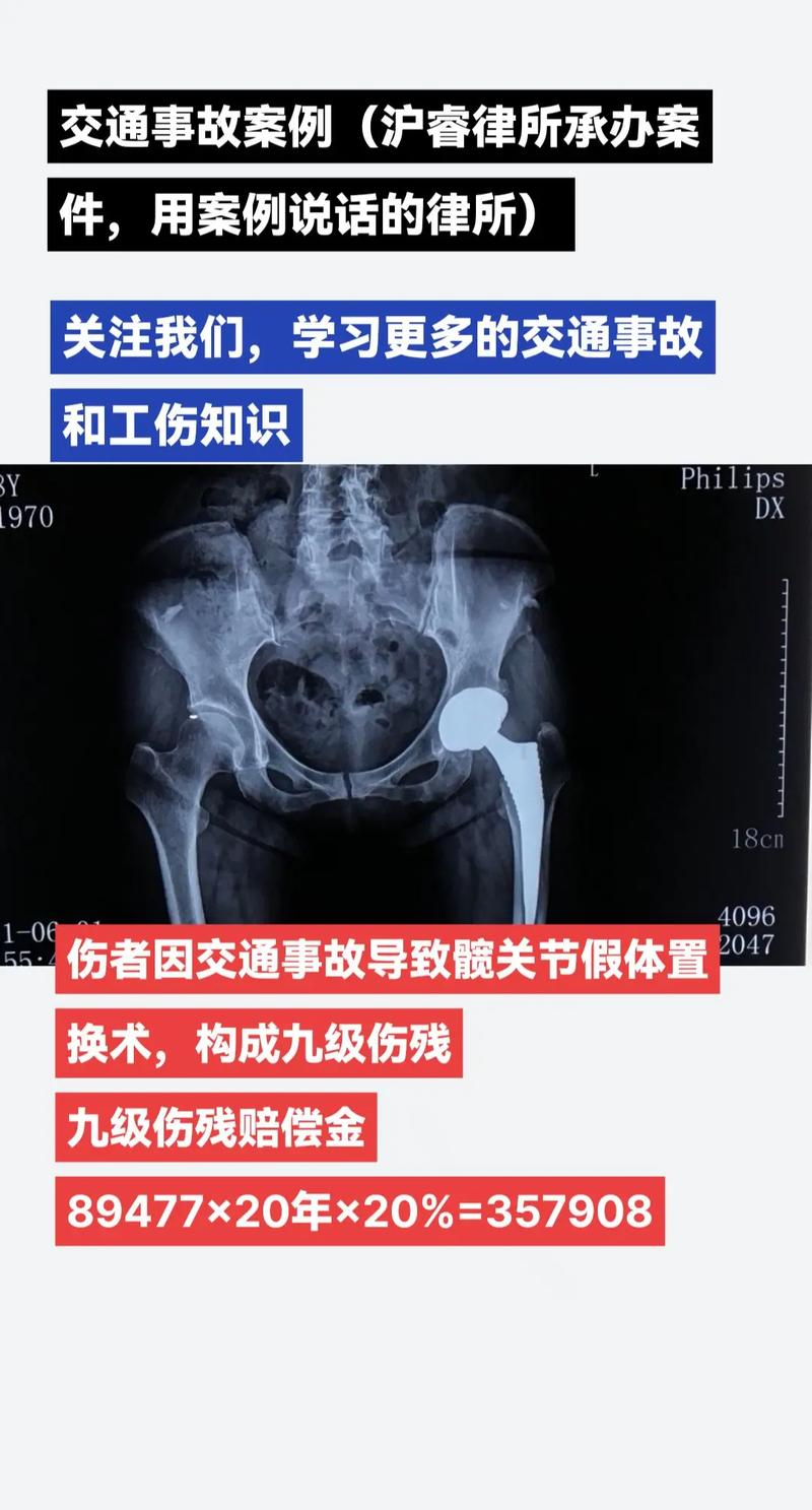 盆骨骨折伤残等级如何判定？专家详解标准与流程