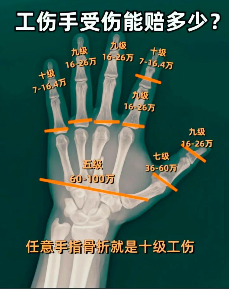 十级伤残到底重不重？律师详解伤残等级与赔偿