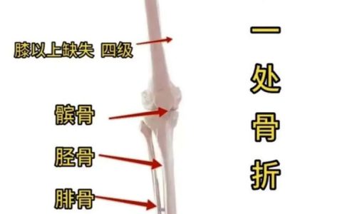 骨折就一定能评上十级伤残吗？专业解读评定标准