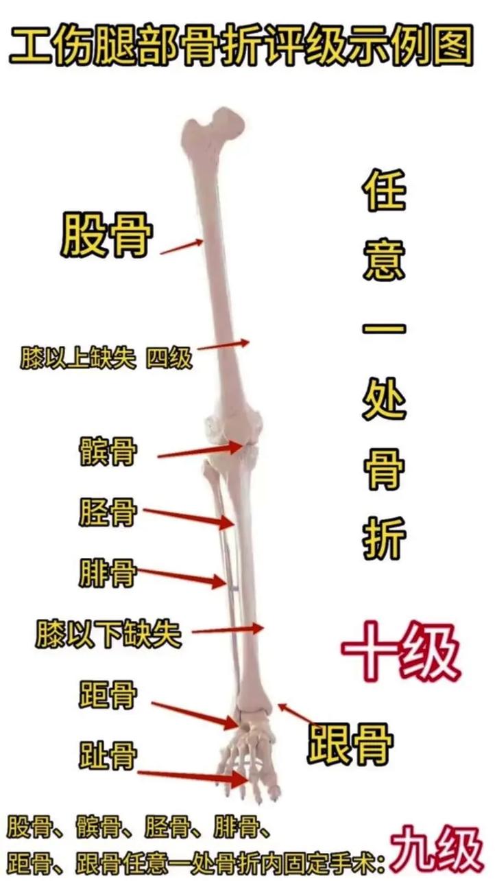 骨折就一定能评上十级伤残吗？专业解读评定标准