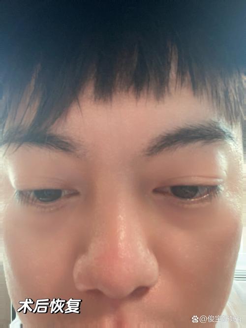 鼻骨骨折是否需要手术？专业解析与处理指南