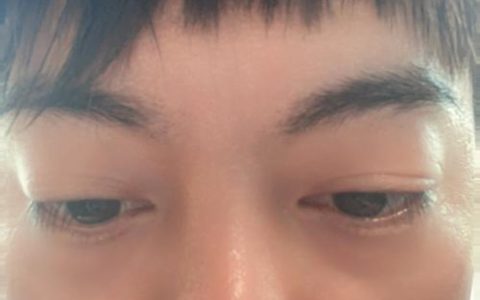 鼻骨骨折是轻伤还是轻微伤？法律认定标准详解
