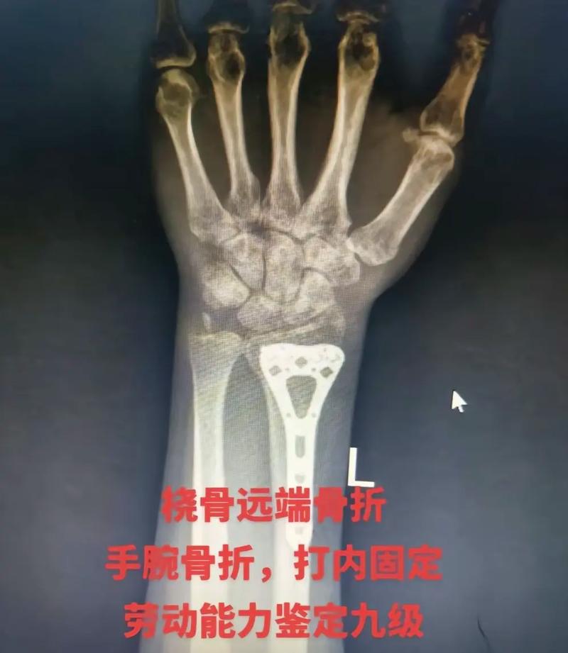骨折伤残等级怎么定？专家解读评定标准及影响