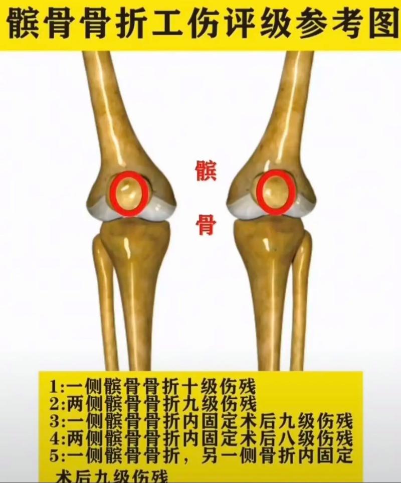 工伤伤残等级1到10级标准详解与权益指南