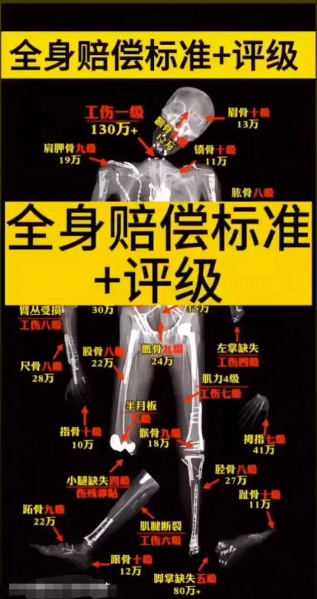 骨折赔偿标准全解析