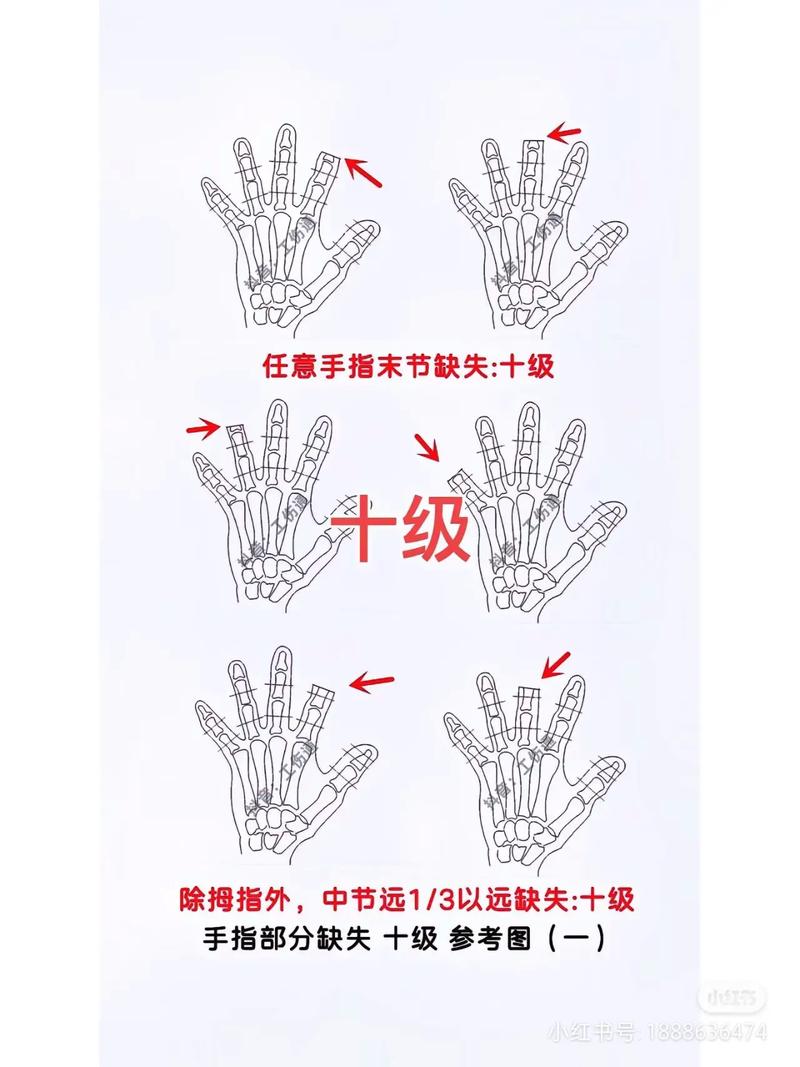 手指伤残等级评定详解