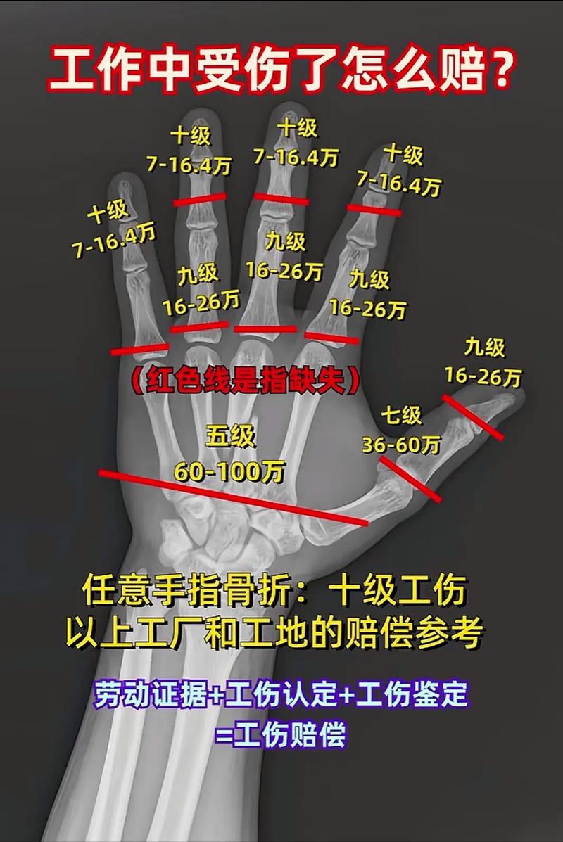 骨折轻伤等级认定标准与维权指南