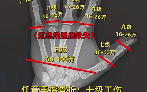 骨折伤残评级标准与赔偿指南