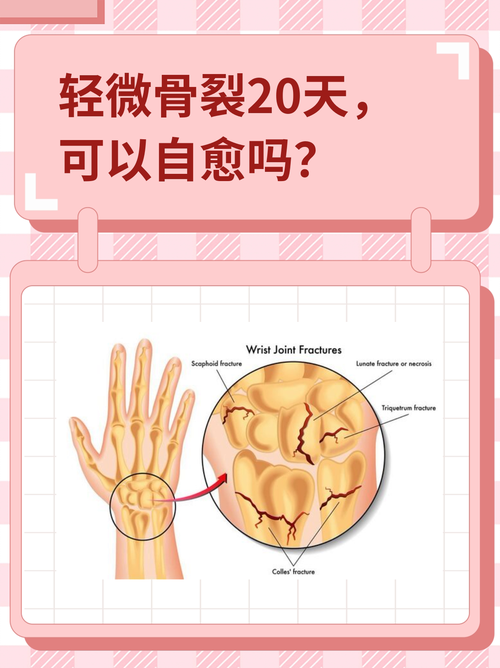 工作时轻微骨裂？工伤等级鉴定与赔偿全解析