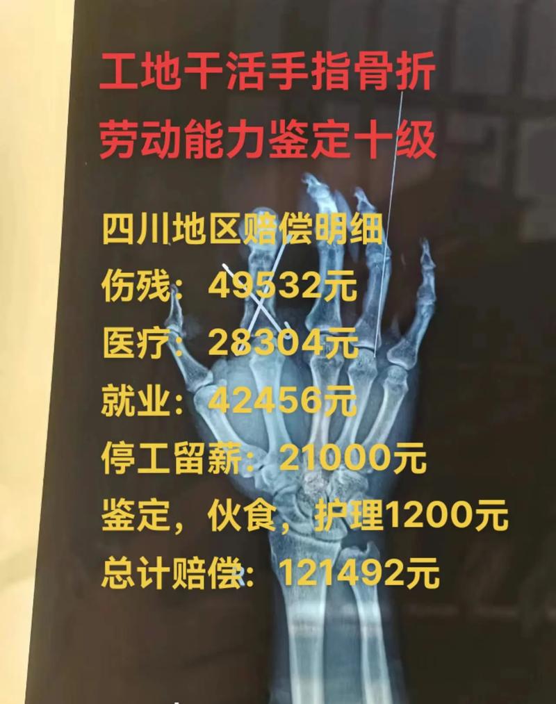 手指工伤：赔偿标准与维权指南