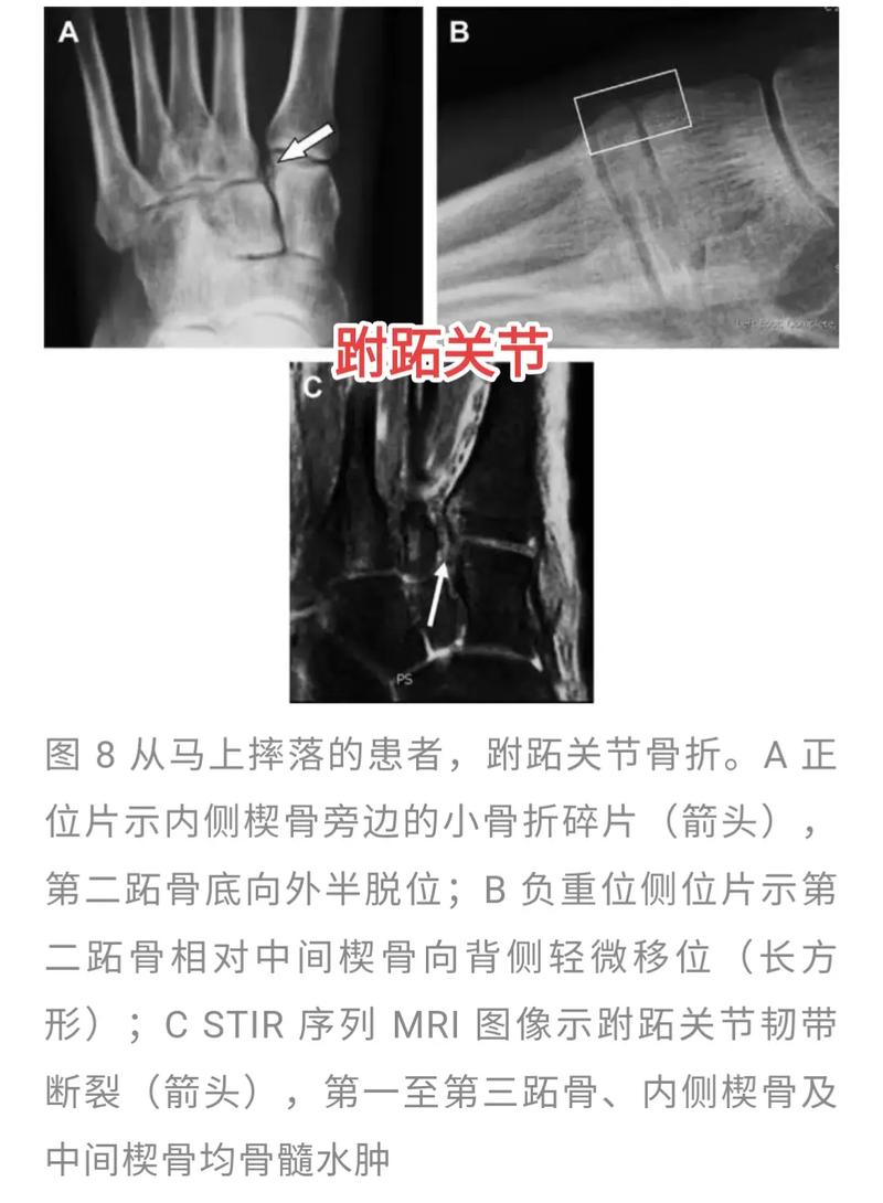 脚踝骨折赔偿标准详解：5万元是否合理