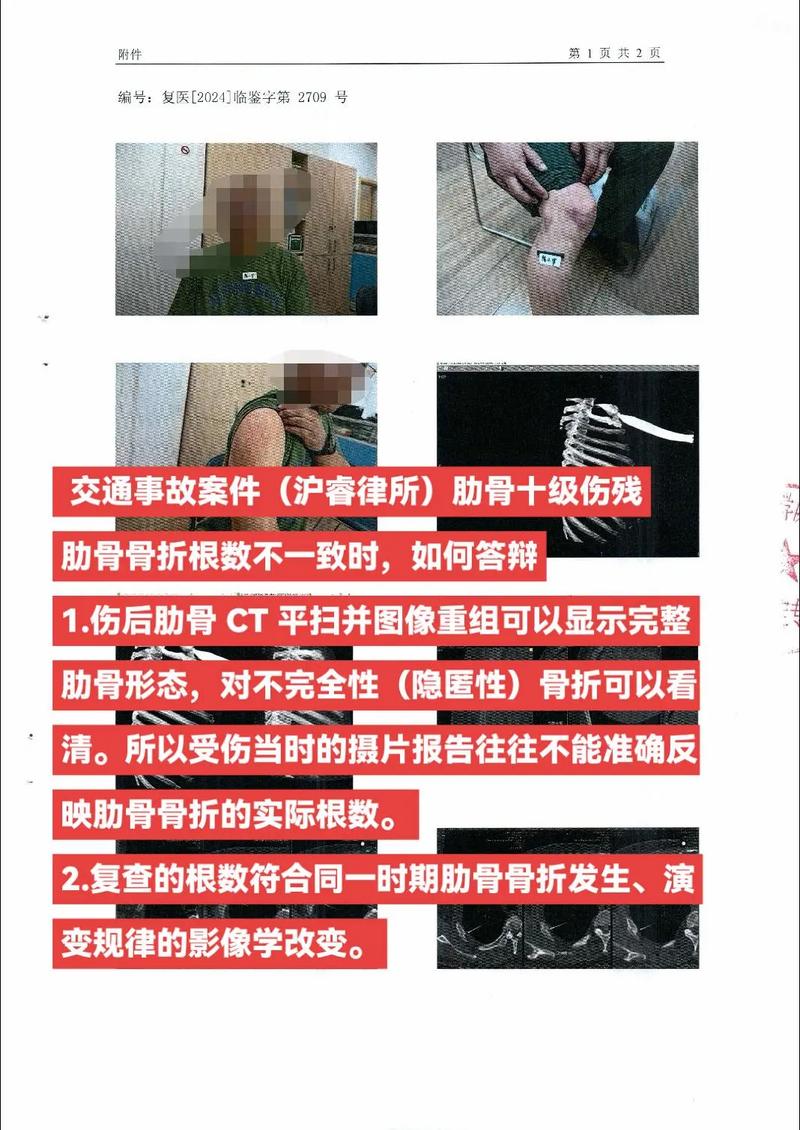 一根肋骨骨折能获赔多少？法律专家深度解析赔偿标准