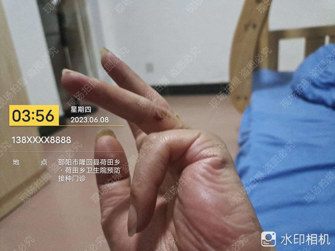 鼻骨骨折轻伤二级鉴定标准与赔偿实务指南