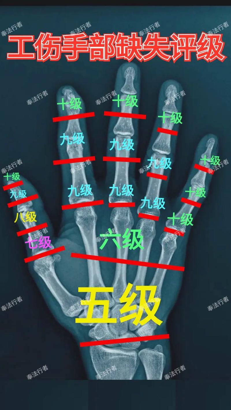 弄懂手指十级伤残：标准、流程与赔偿