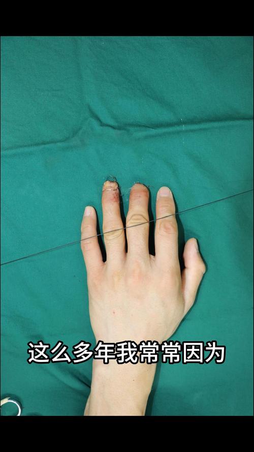 指尖上的重生：人工骨再造手指的希望与现实