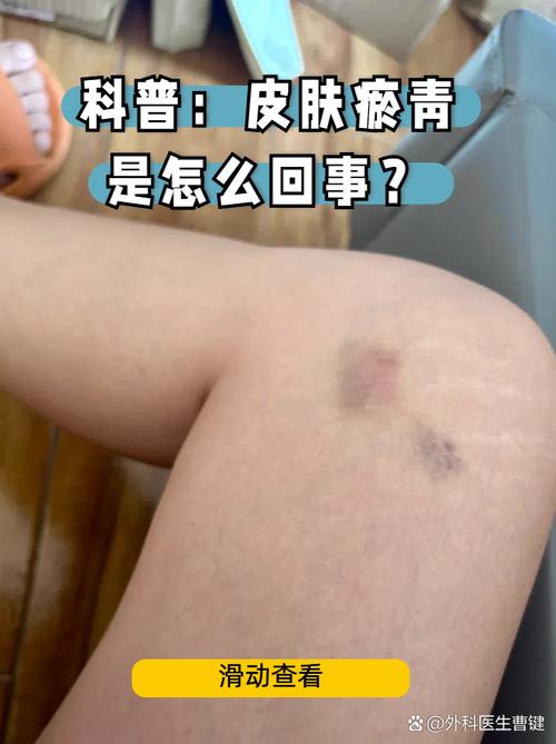 淤青不容小觑：伤情鉴定标准与维权要点解析