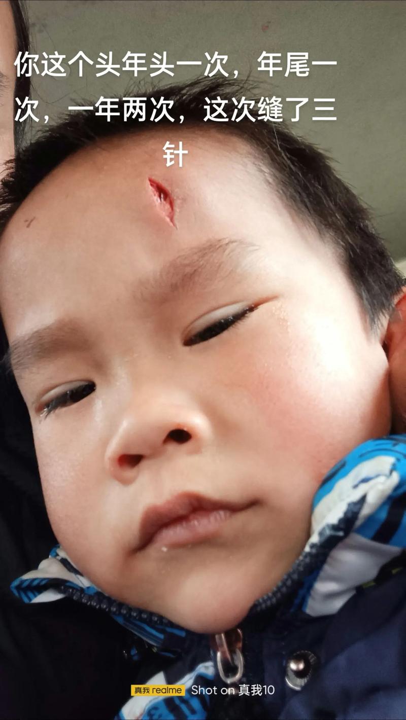 头部受伤缝针不可小觑，法律赔偿项目全解析