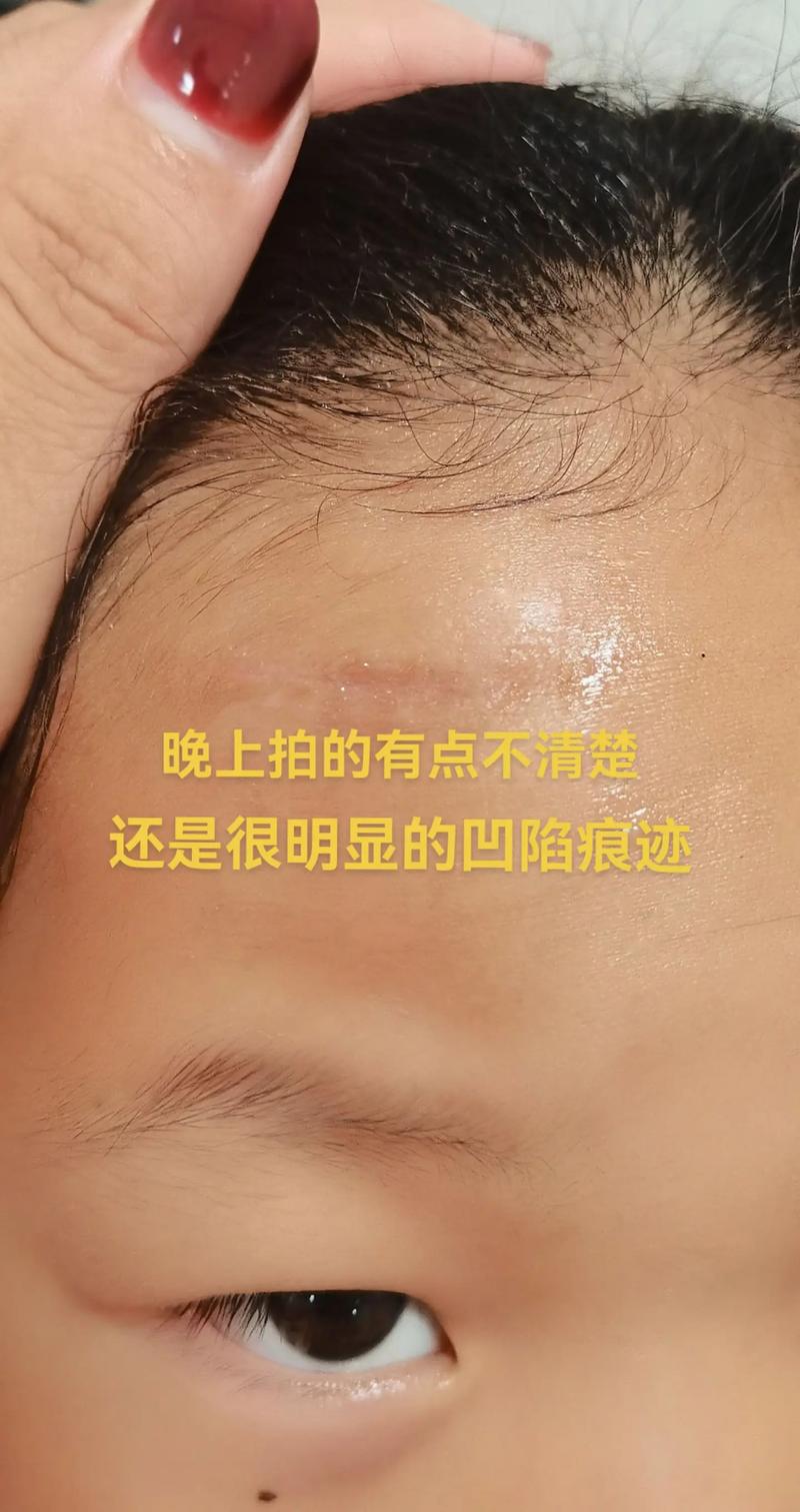 拆线后多久能好？科学护理加速恢复秘诀