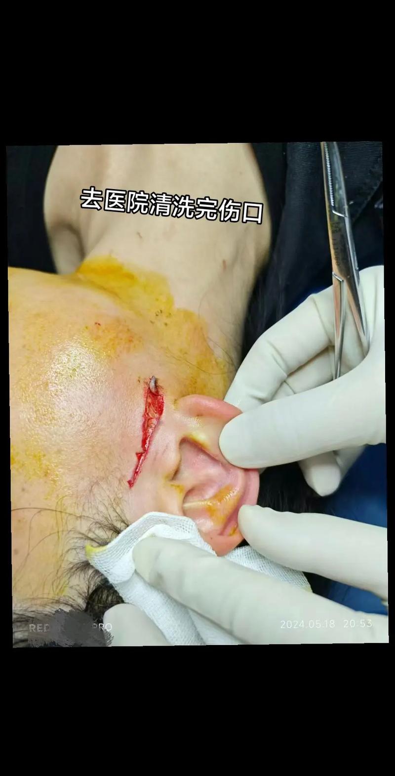 伤口缝针数量与赔偿：法律视角下的真相