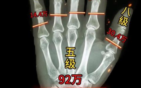 手部骨折伤残等级认定：法律专家深度解析与指引