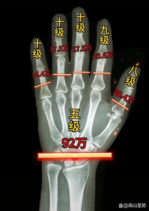 手部骨折伤残等级认定：法律专家深度解析与指引