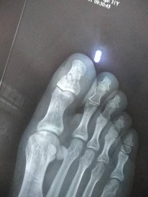 小腿骨折伤残等级与赔偿标准解析