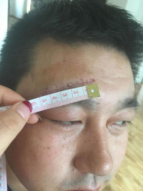 轻伤二级赔偿并非价目表，别被数字迷惑